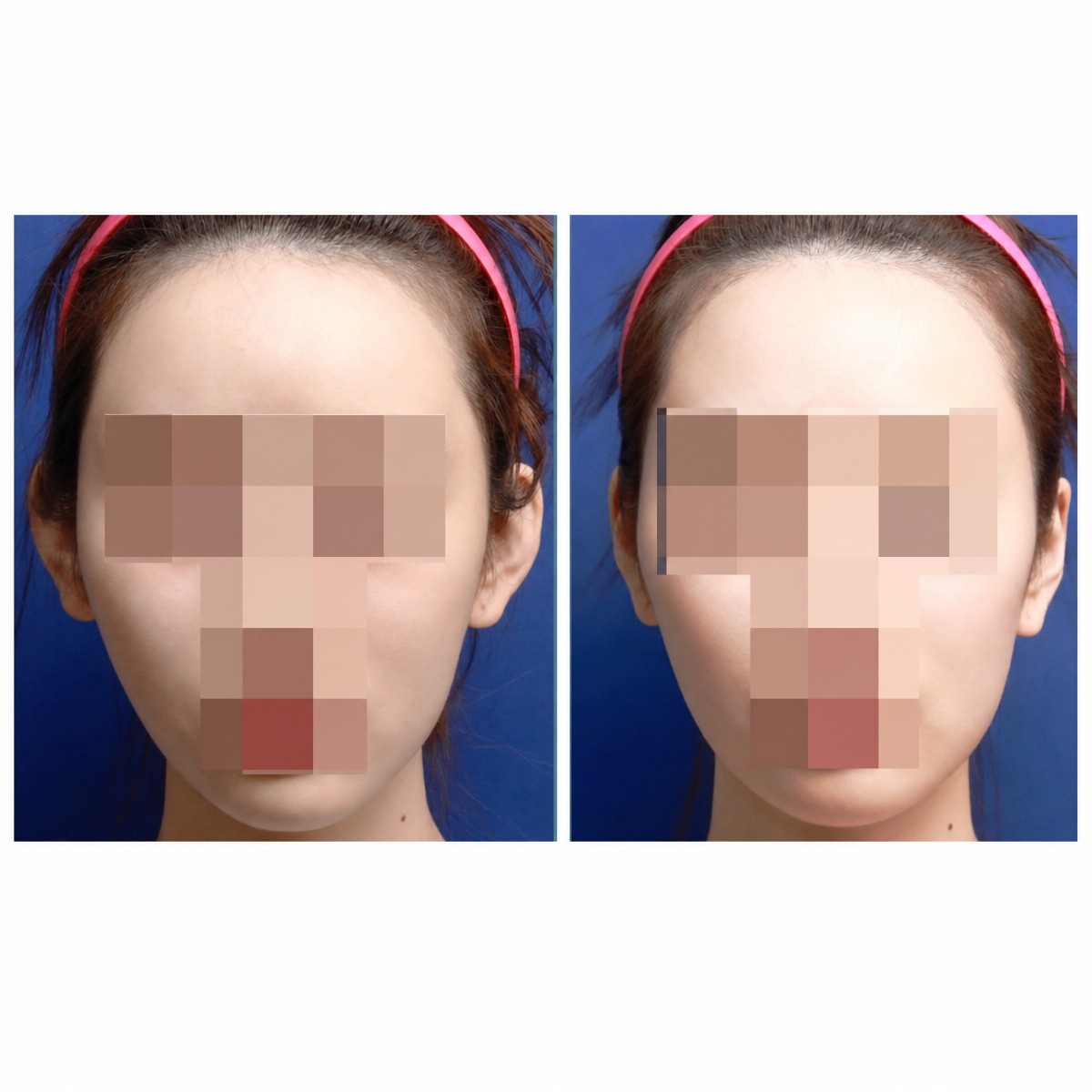 Vorher-nachher-Otoplastik-Ergebnisse bei SAERO Plastic Surgery, verbesserte Ohrsymmetrie
