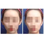 Résultats de la procédure Otoplastie (chirurgie des oreilles) par le Dr Park Young Kyu - Photos avant et après des patients Photos avant et après par le Dr Park Young Kyu