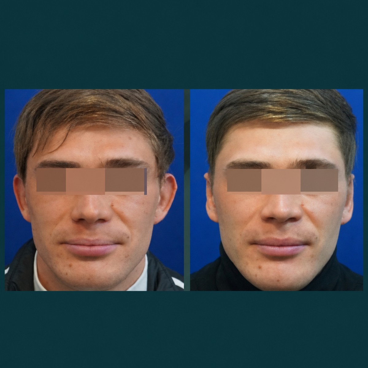 Vorher-nachher-Otoplastik-Ergebnisse bei SAERO Plastic Surgery, verbesserte Ohrsymmetrie