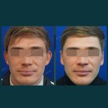 Résultats de la procédure Otoplastie (chirurgie des oreilles) par le Dr Park Young Kyu - Photos avant et après des patients Photos avant et après par le Dr Park Young Kyu