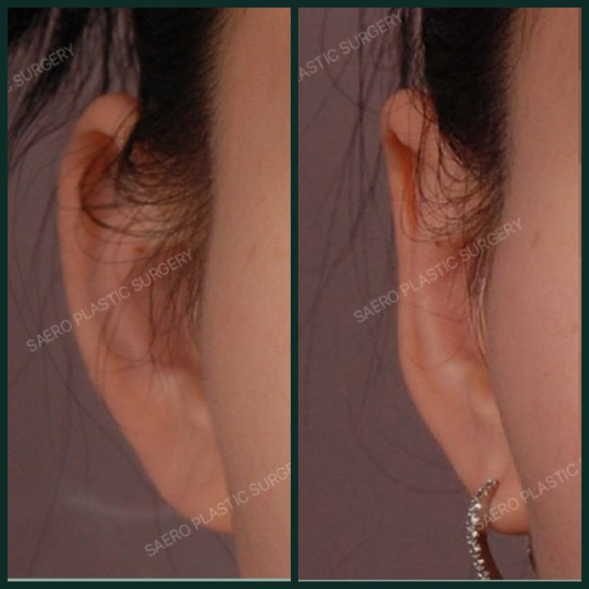 نتائج عملية تجميل الأذن قبل وبعد في SAERO Plastic Surgery، تحسين شكل الأذن
