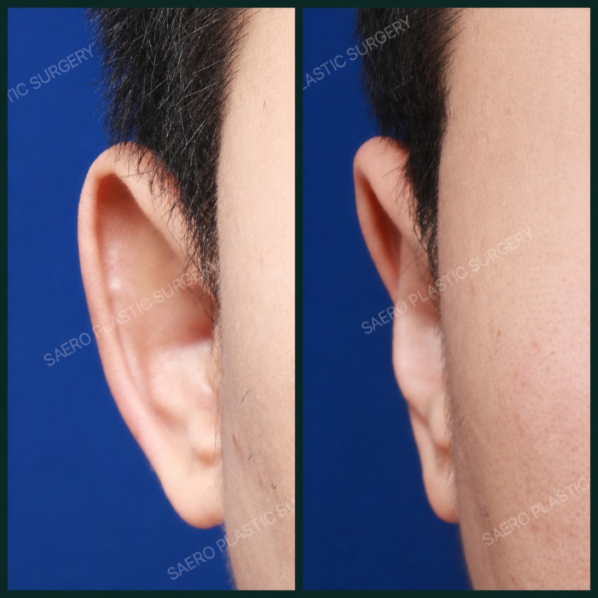 نتائج عملية تجميل الأذن قبل وبعد في SAERO Plastic Surgery، تحسين شكل الأذن