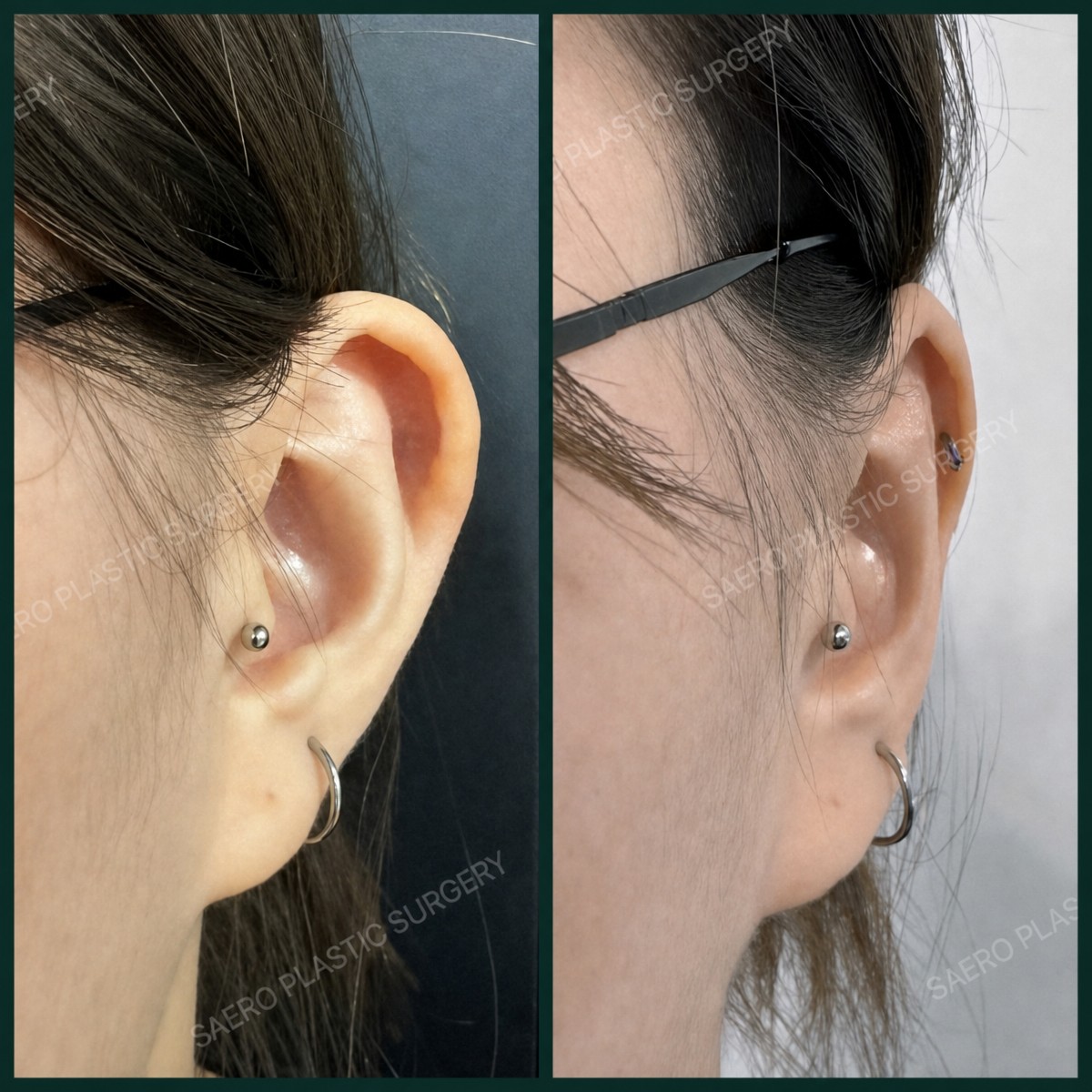 Результаты отопластики до и после в SAERO Plastic Surgery, улучшение формы уха