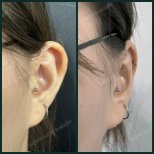 Résultats de la procédure Otoplastie (chirurgie des oreilles) par le Dr Park Young Kyu - Photos avant et après des patients Photos avant et après par le Dr Park Young Kyu