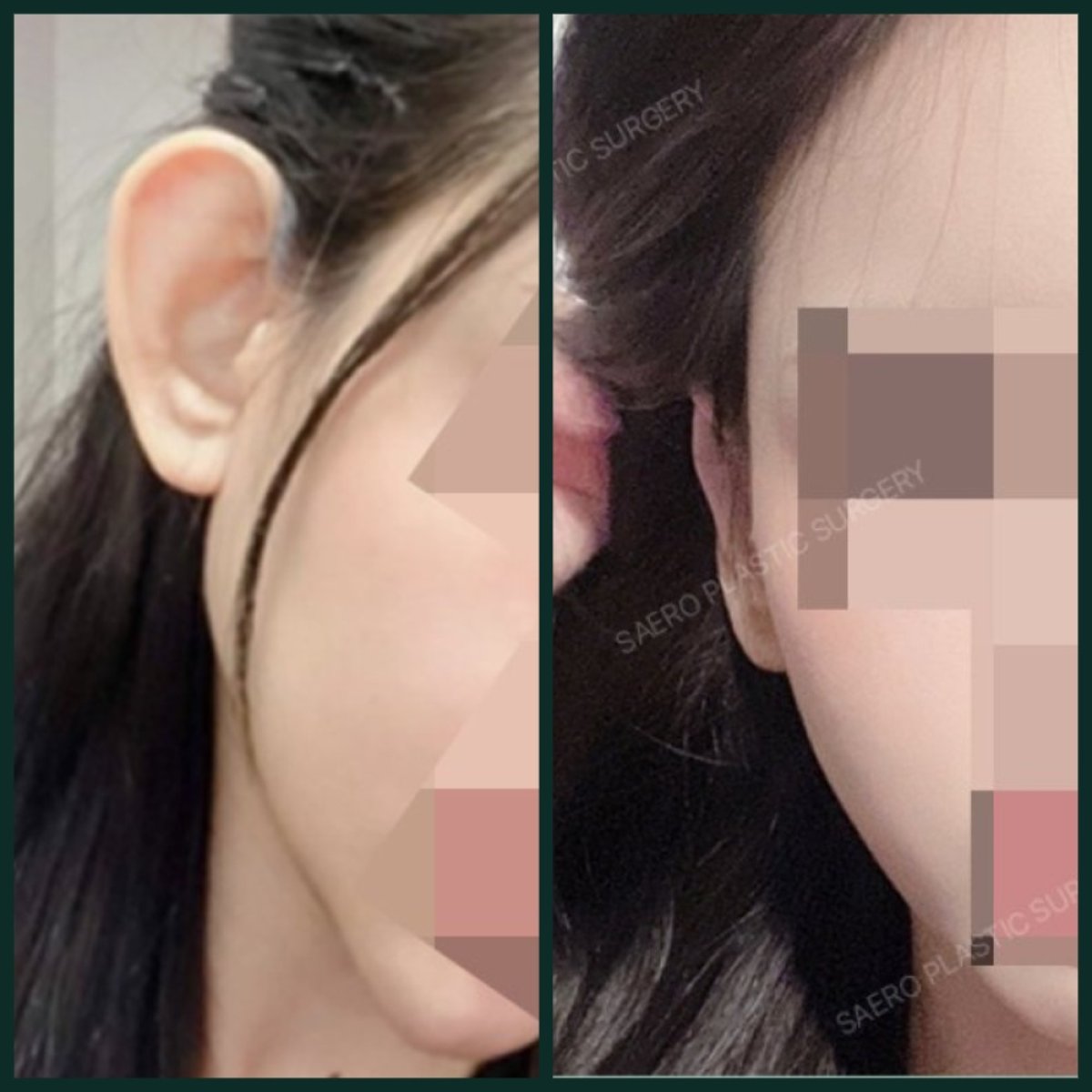 نتائج تجميل الأذن قبل وبعد في SAERO Plastic Surgery، تحسين شكل الأذن