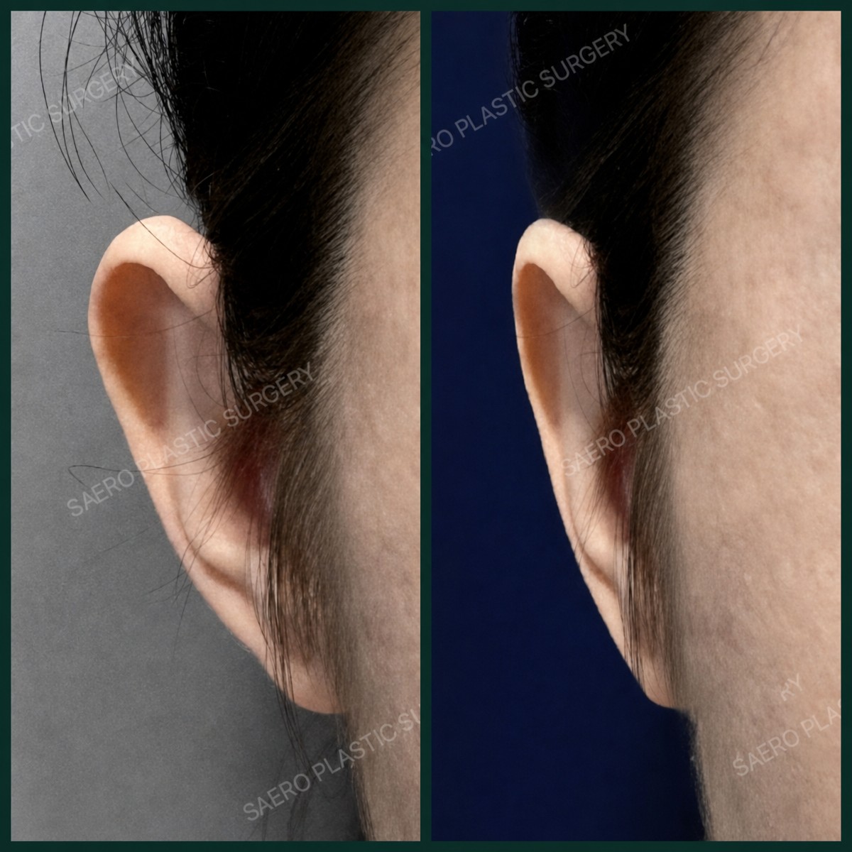 Before and after otoplasty results at SAERO Plastic Surgery, ear reshaping improvement