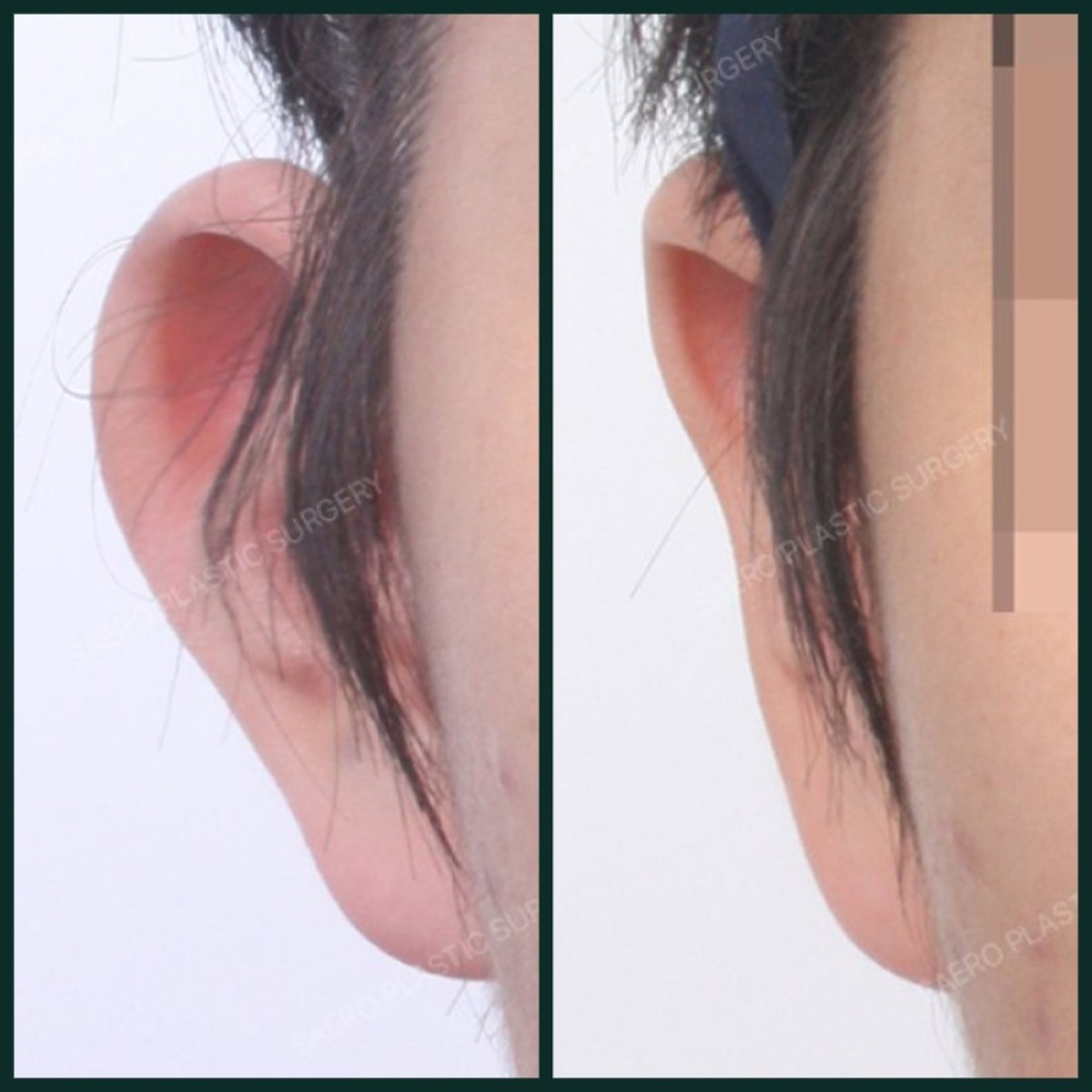 نتائج تجميل الأذن قبل وبعد في SAERO Plastic Surgery، تحسين شكل الأذن