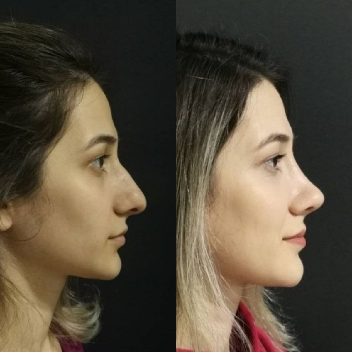 نتائج عملية تجميل الأنف قبل وبعد في Optimed International، تحسين شكل الأنف