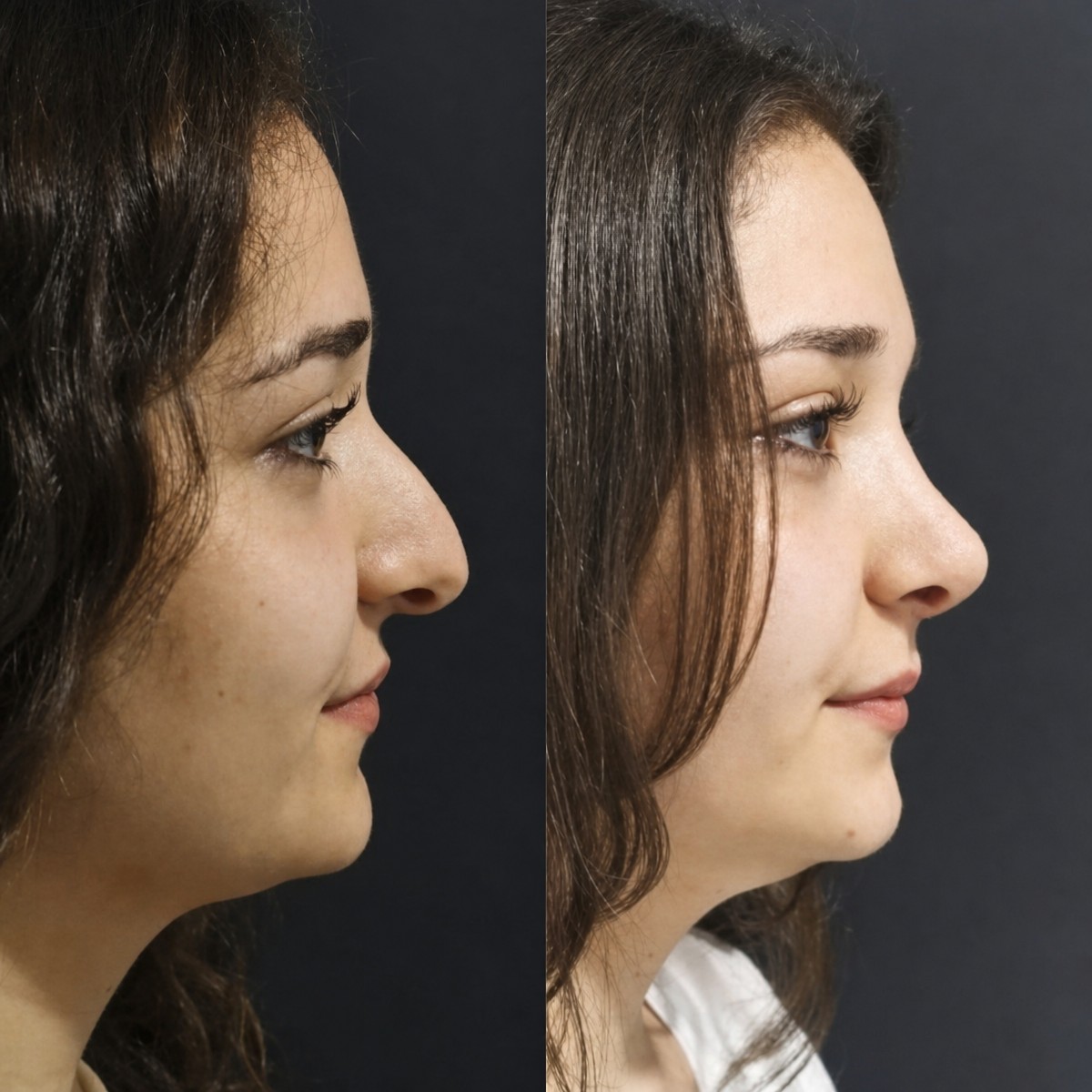 Before and after rhinoplasty result at Optimed International, improved nose profile