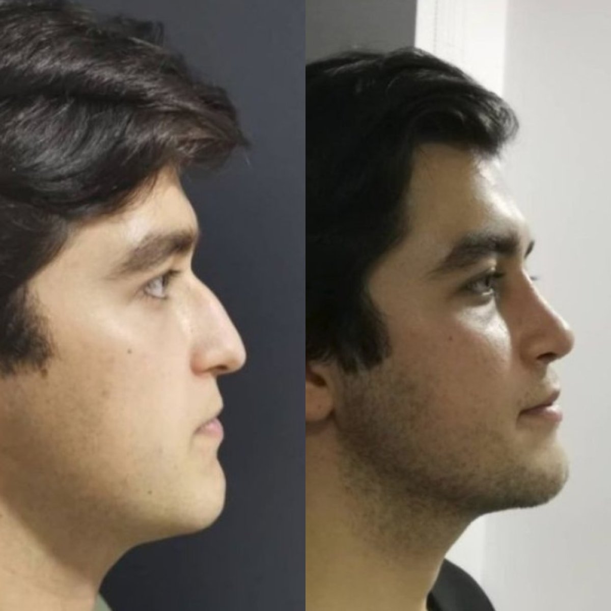 نتائج عملية تجميل الأنف قبل وبعد في Optimed International، تحسين شكل الأنف الجانبي