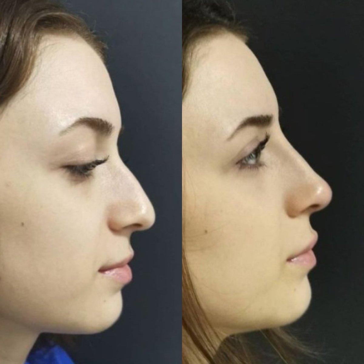 Resultados de rinoplastia antes y después en Optimed International, perfil nasal mejorado