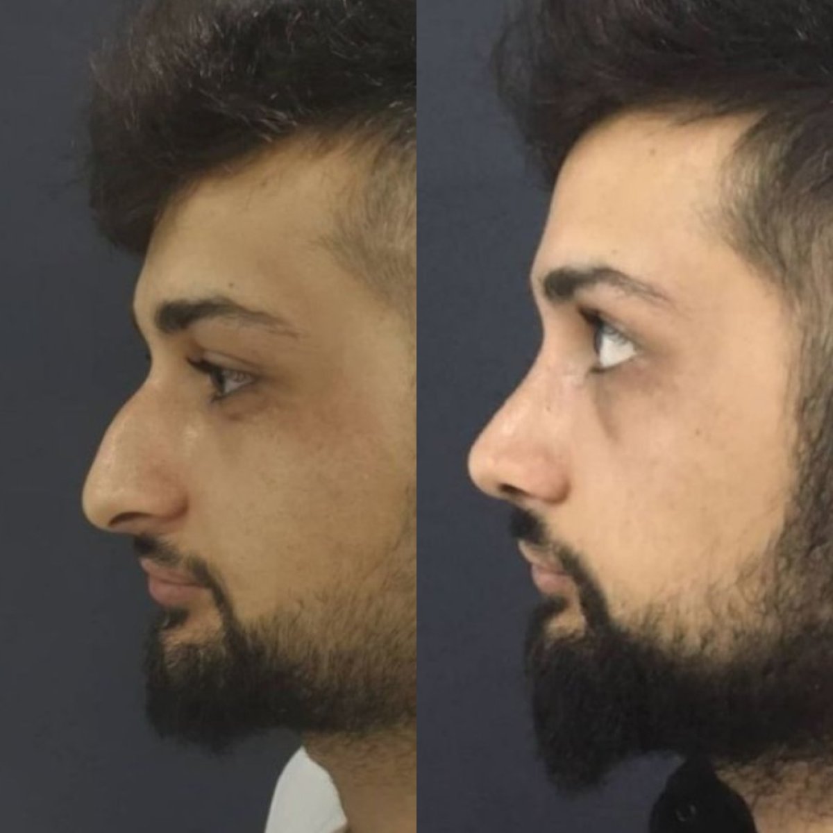 Resultados de rinoplastia antes y después en Optimed International, perfil nasal mejorado