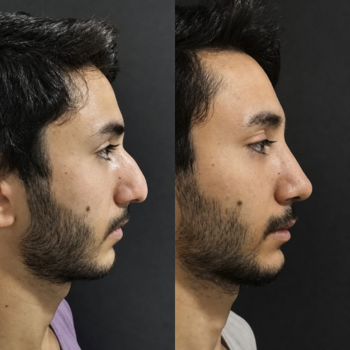 Resultados de rinoplastia antes y después en Optimed International, perfil nasal mejorado en hombres
