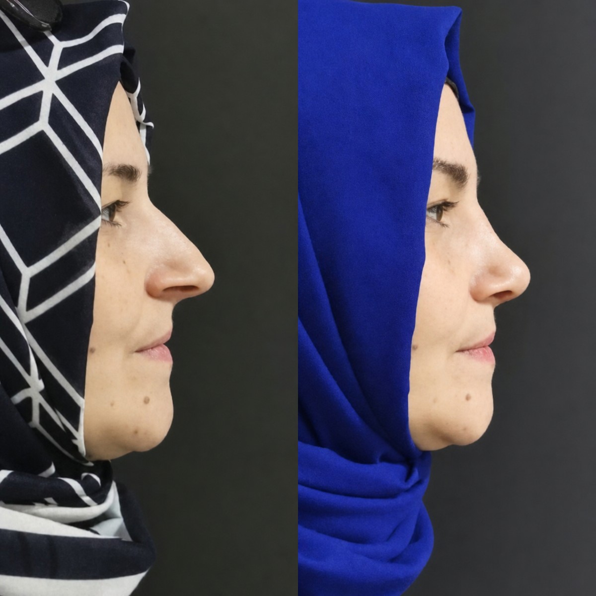 نتيجة عملية تجميل الأنف قبل وبعد في Optimed International، تحسين شكل الأنف الجانبي