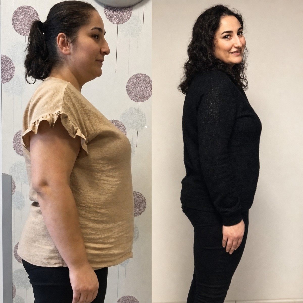 Before and after gastric sleeve surgery at Optimed International – visible weight loss result