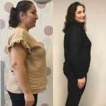 Before and after Gastric balloon photos by Dr. Onder Surgit