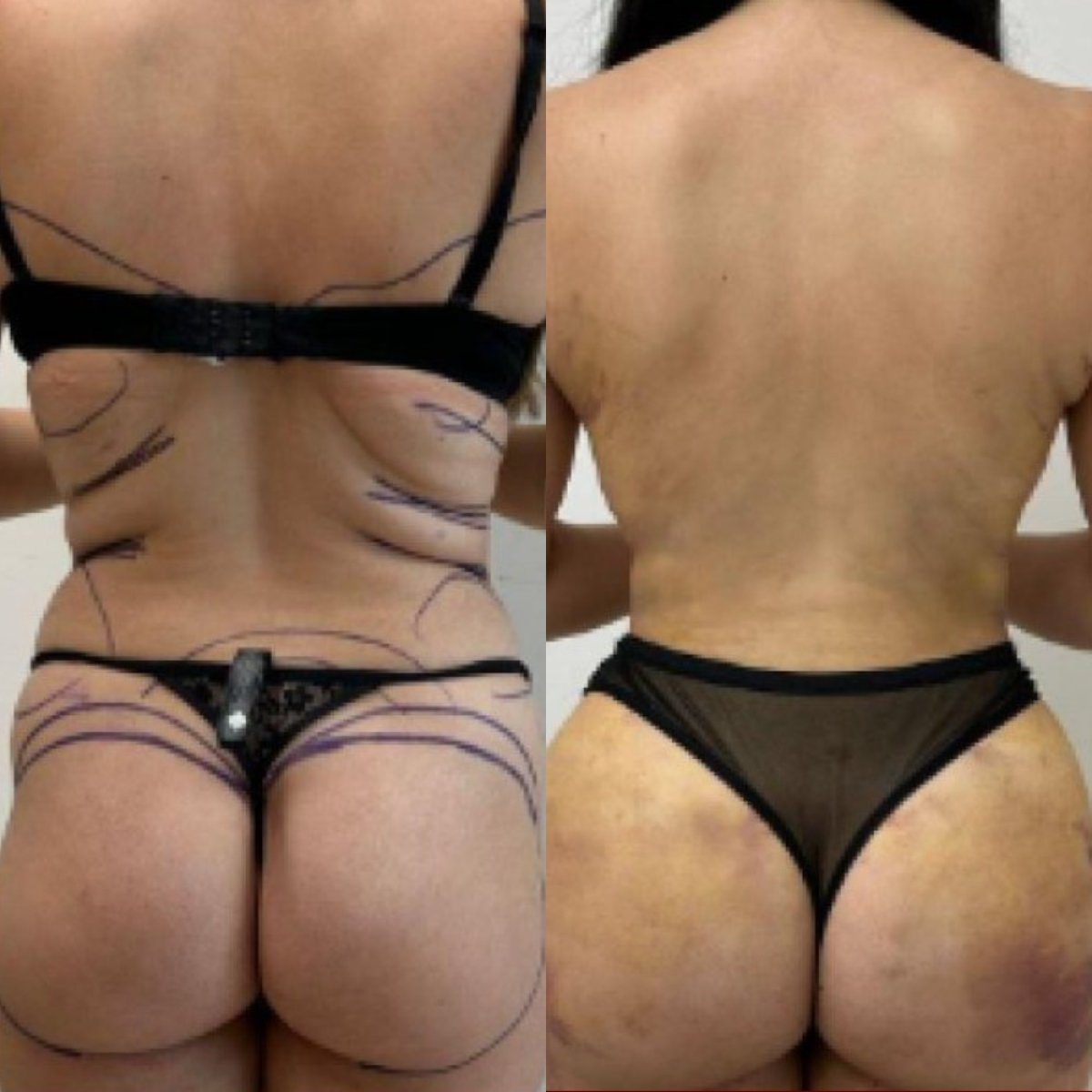 نتائج قبل وبعد عملية Brazilian Butt Lift في Optimed International، تحسين شكل الجسم