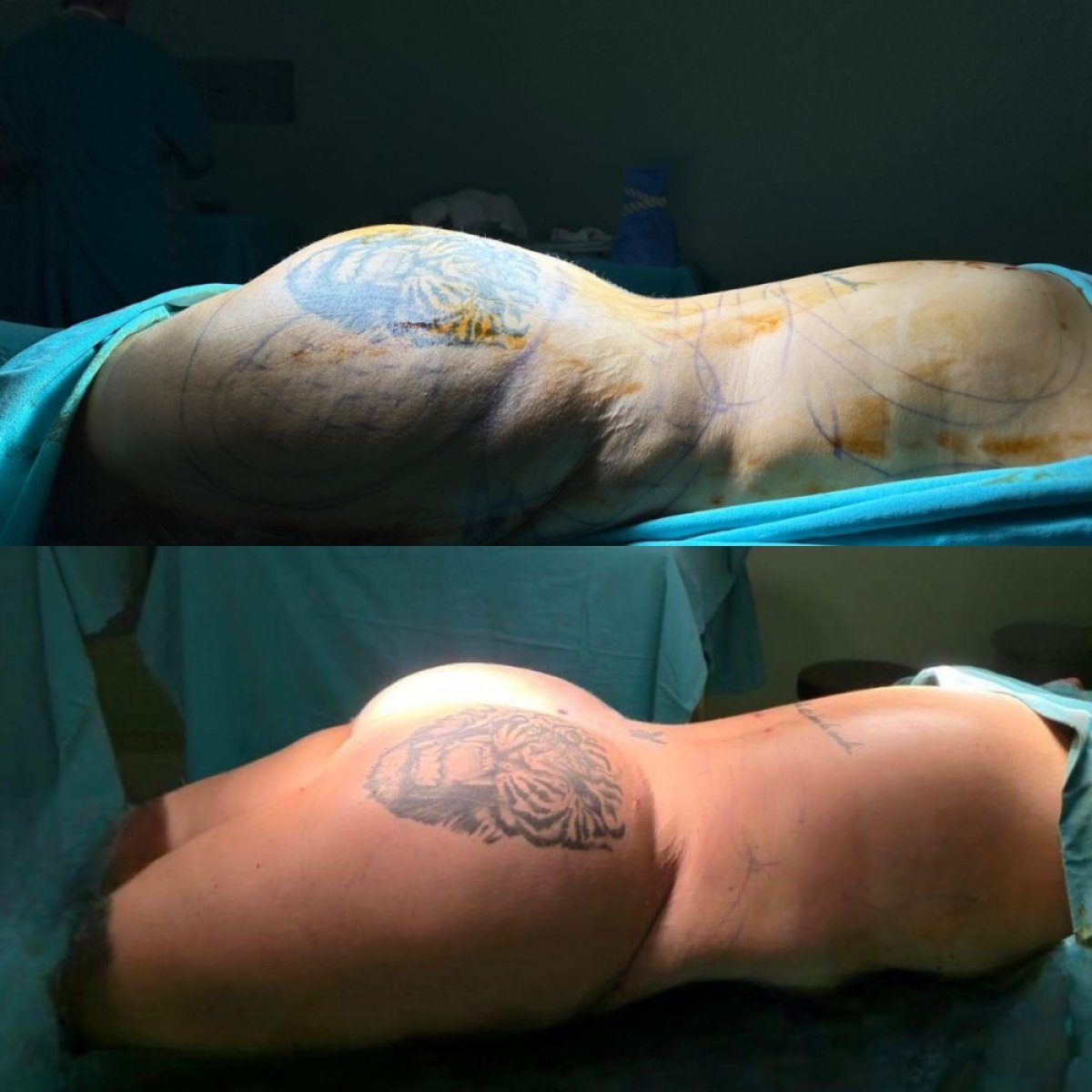 نتائج قبل وبعد عملية Brazilian Butt Lift في Optimed International – تحسين الشكل