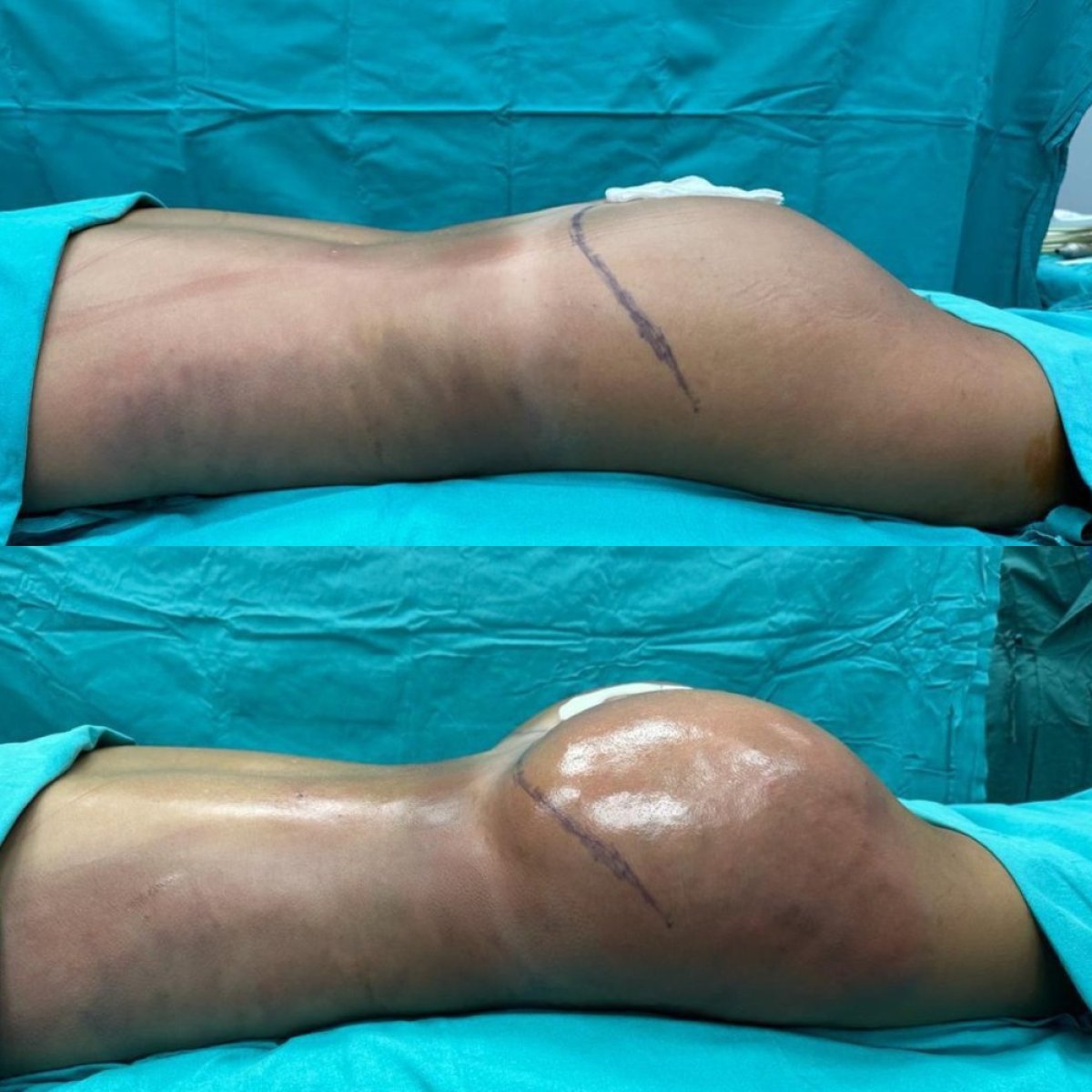 نتائج قبل وبعد عملية Brazilian Butt Lift في Optimed International – تحسين شكل الأرداف