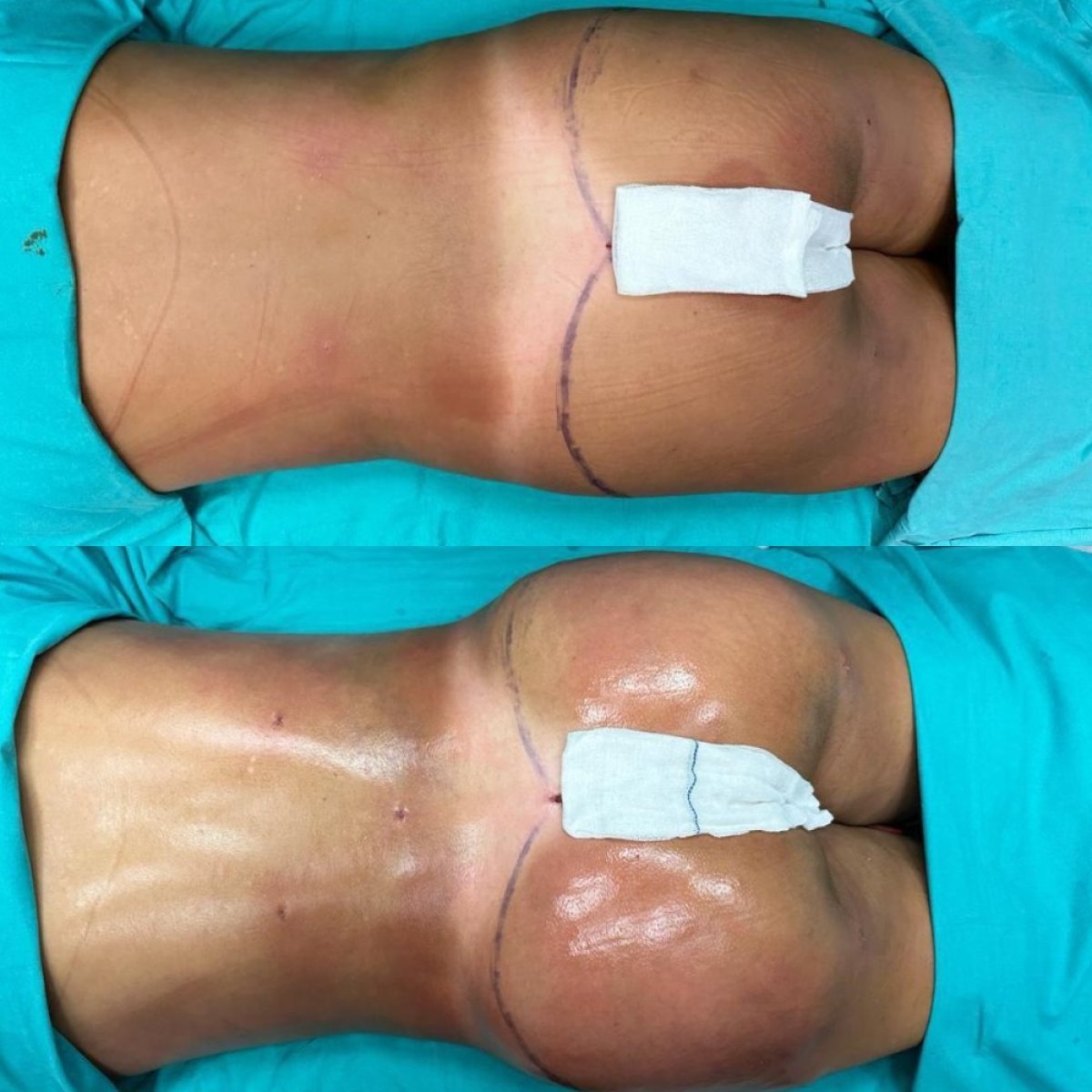 نتائج قبل وبعد عملية Brazilian Butt Lift في Optimed International – تحسين شكل الأرداف