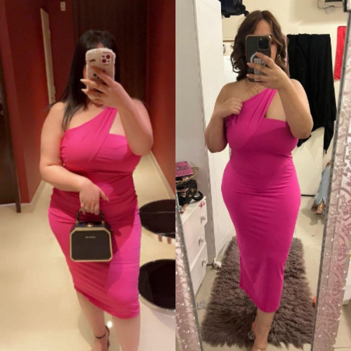 Before and after liposuction results at Optimed International – visible body contour improvement