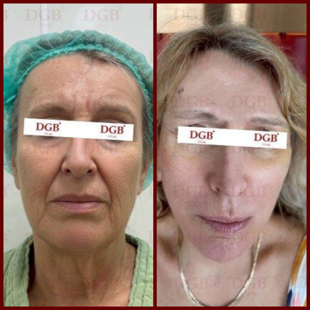 Resultados de lifting facial antes y después en DGB Clinic, rejuvenecimiento visible