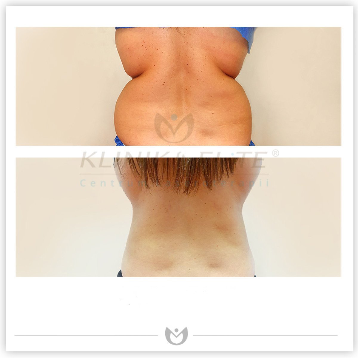 Before and after liposuction results at Klinika Elite – visible back contour improvement