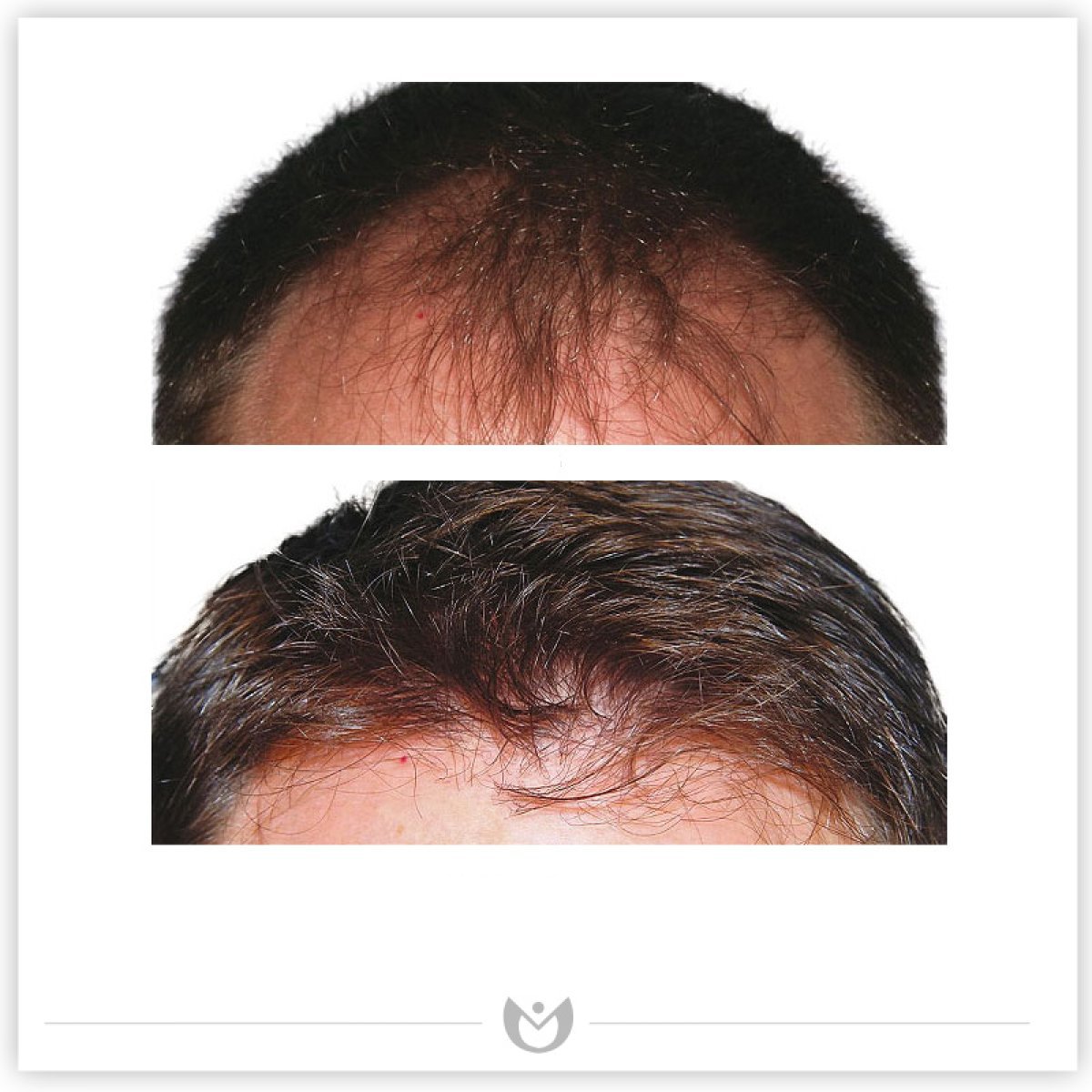 Résultats avant/après greffe de cheveux à Klinika Elite – ligne capillaire restaurée