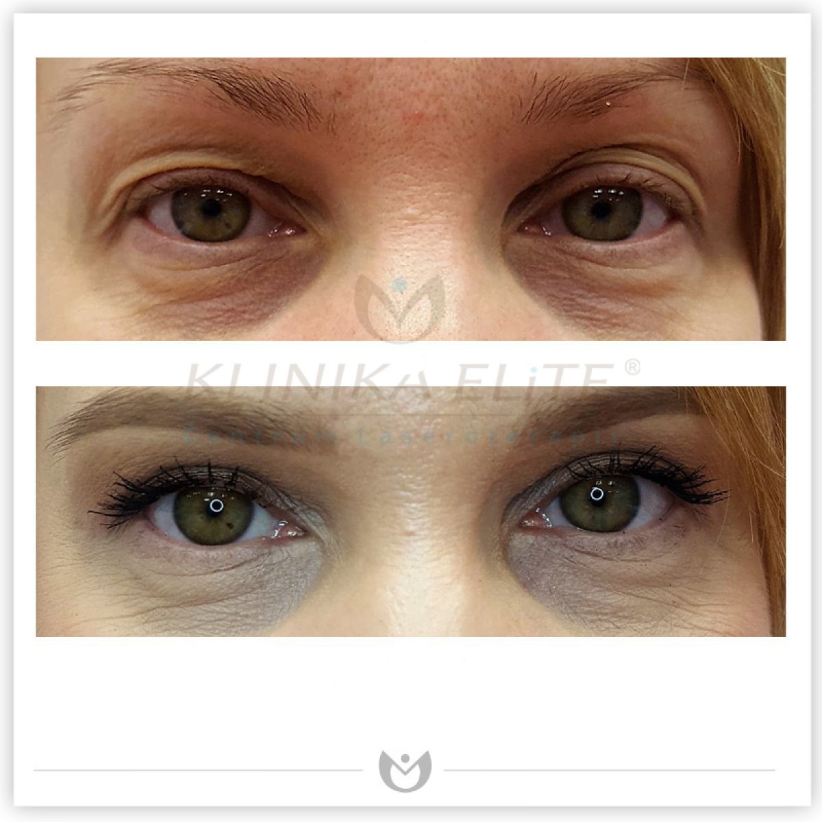 Before and after blepharoplasty results at Klinika Elite, eyelid correction for youthful eyes