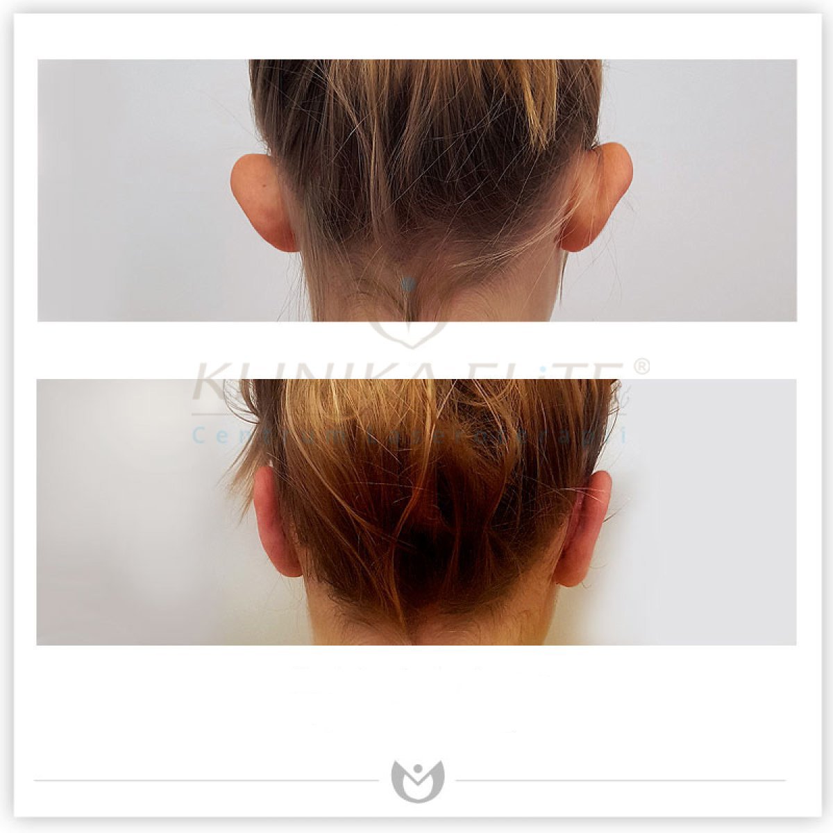 Résultats avant/après otoplastie à Klinika Elite – remodelage naturel des oreilles