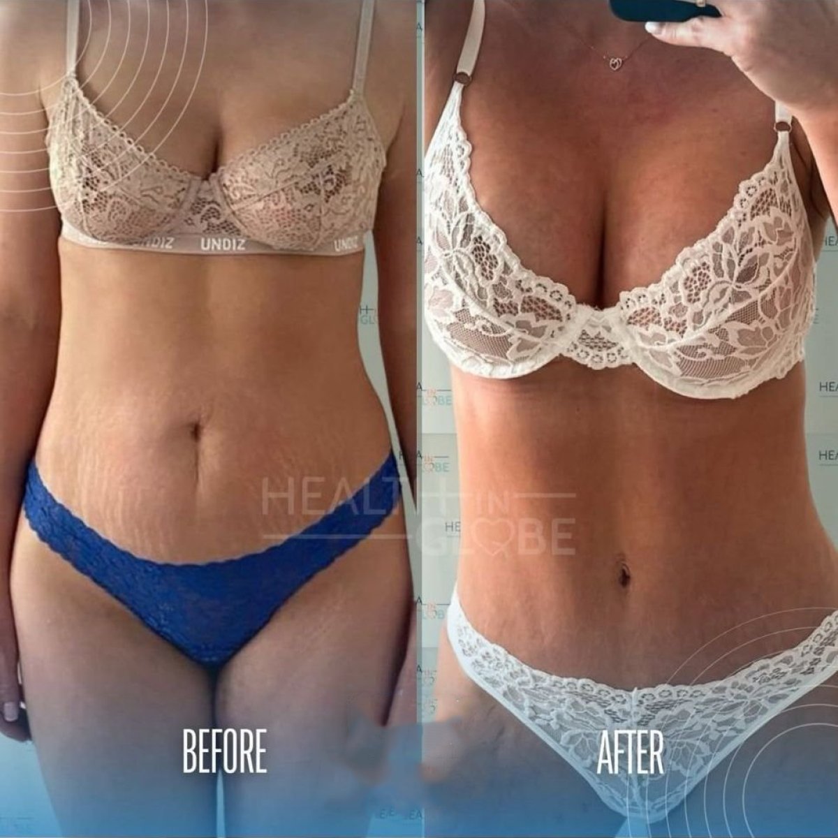 Mommy makeover before and after results at Memorial Şişli Hospital, body contour improvement