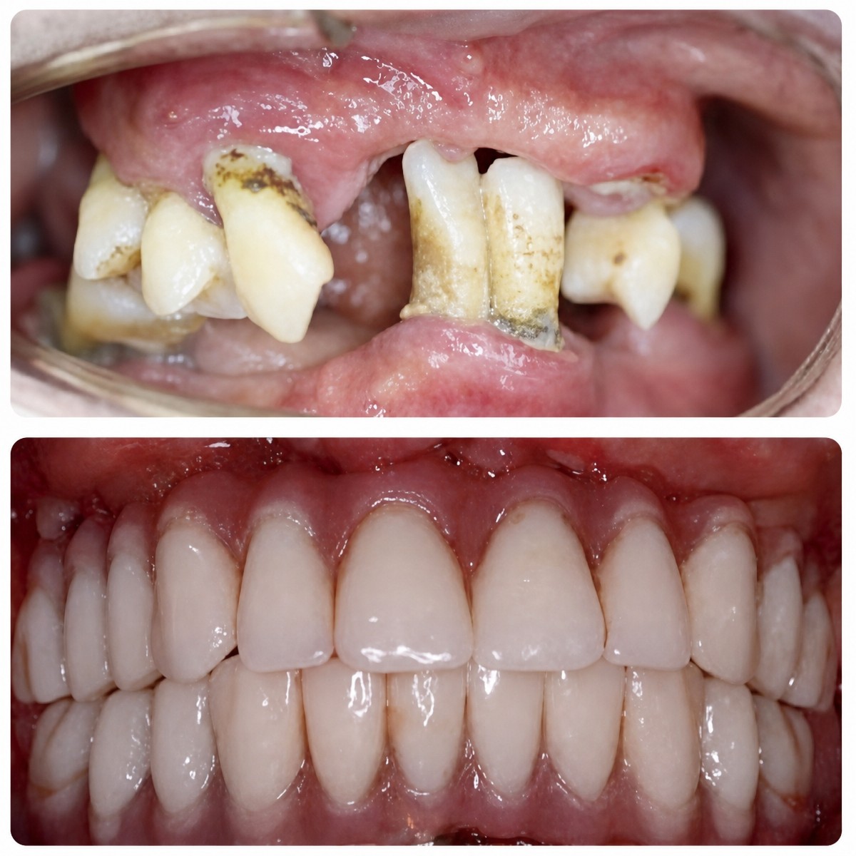 Efekt przed i po implantach All-on-4 w Wuhan Yiya Simei Dental Hospital