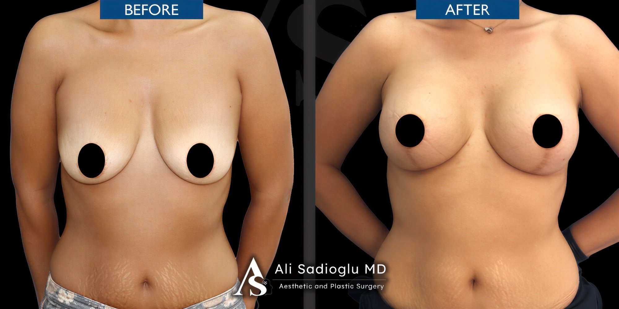 Resultados antes y después de implantes mamarios con lifting en Dr. Safa Manav Clinic