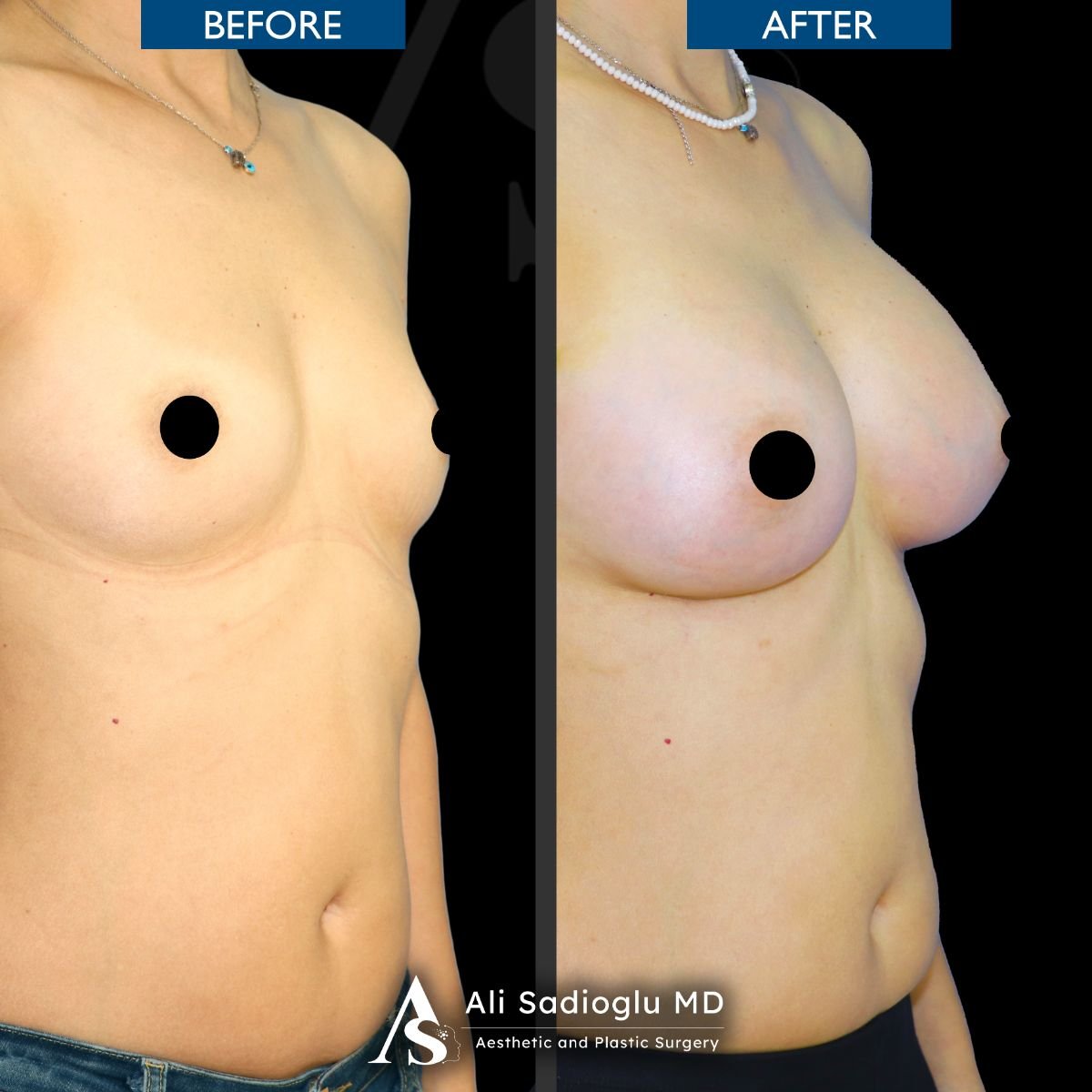 Resultados antes y después de implantes y levantamiento de senos en Dr. Safa Manav Clinic