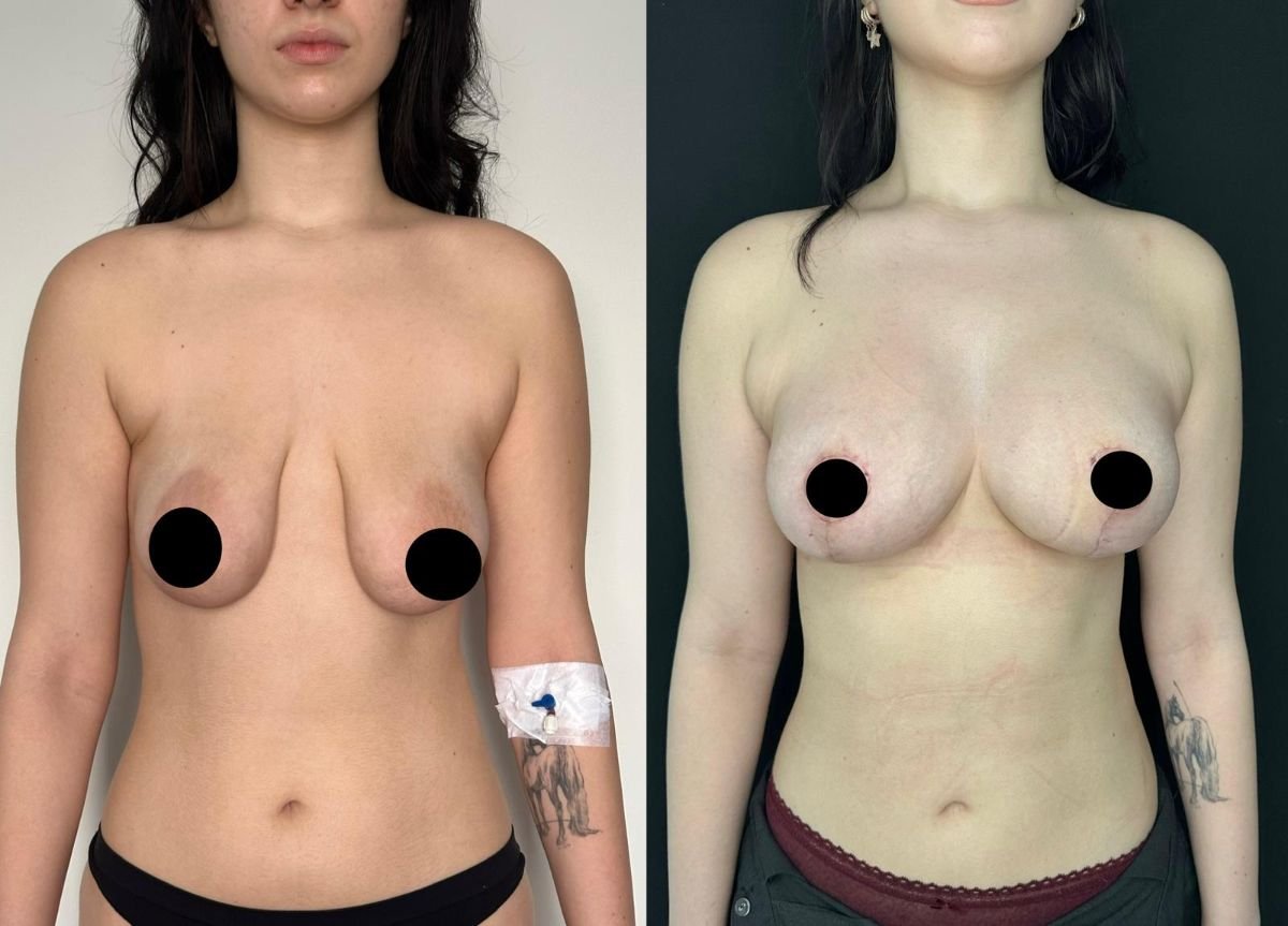 Результаты до и после увеличения груди с подтяжкой в клинике Dr. Safa Manav, улучшенный контур