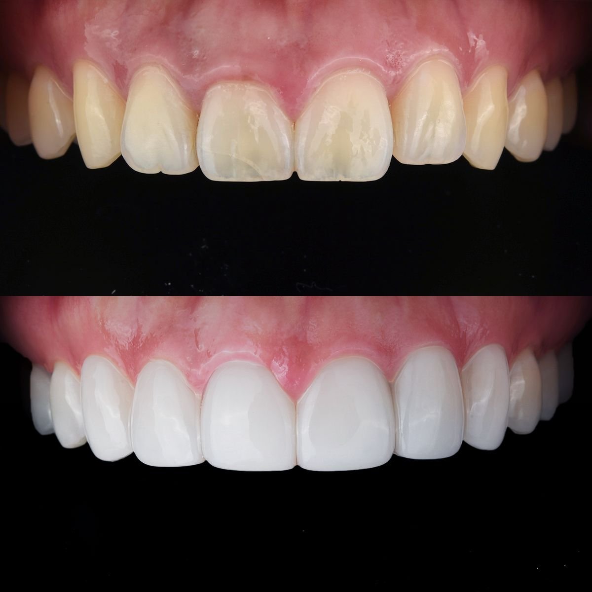 До та після встановлення вінірів у 365 Seoul OneTop Dental Clinic – результат зміни усмішки
