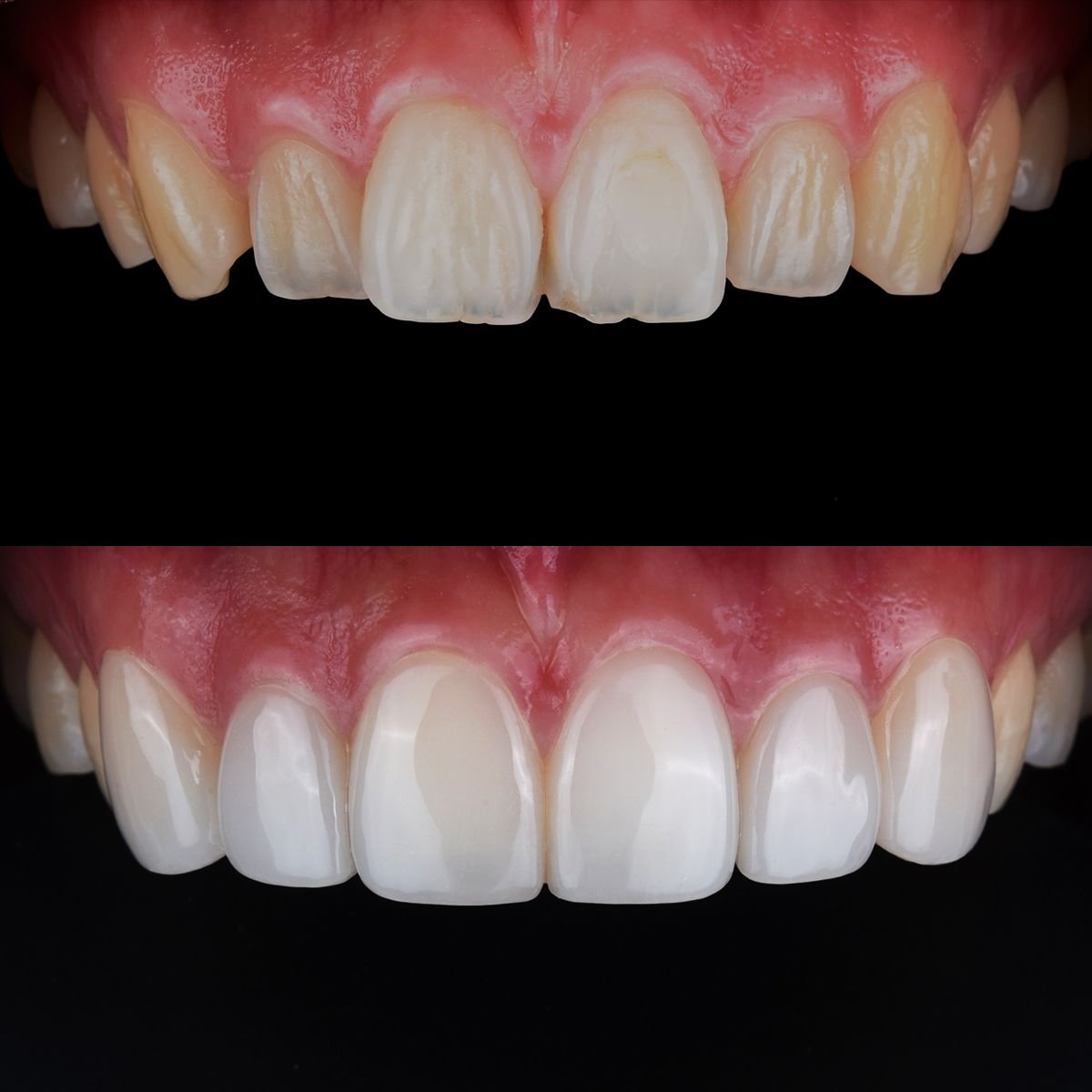 Результат до и после установки виниров в 365 Seoul OneTop Dental Clinic, преображение улыбки