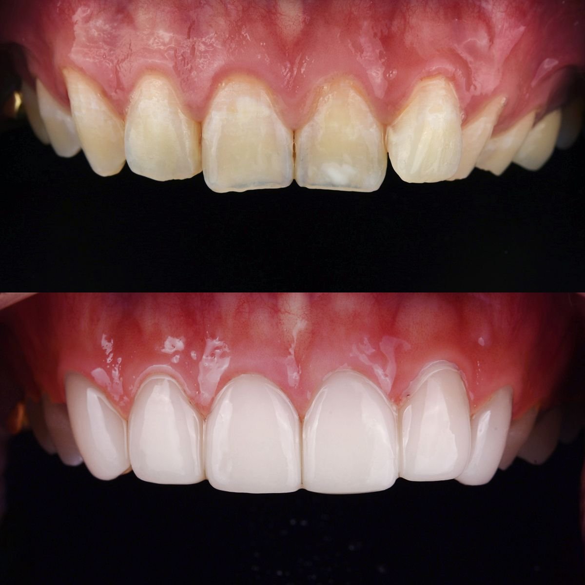 نتيجة قبل وبعد الفينير في عيادة 365 Seoul OneTop Dental Clinic، تحول الابتسامة