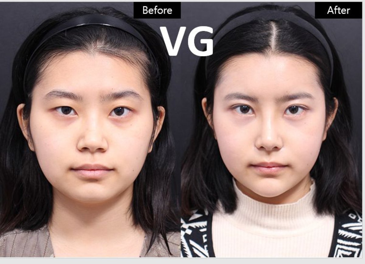 Before and after jawline contouring results at VG Plastic Surgery – defined facial shape