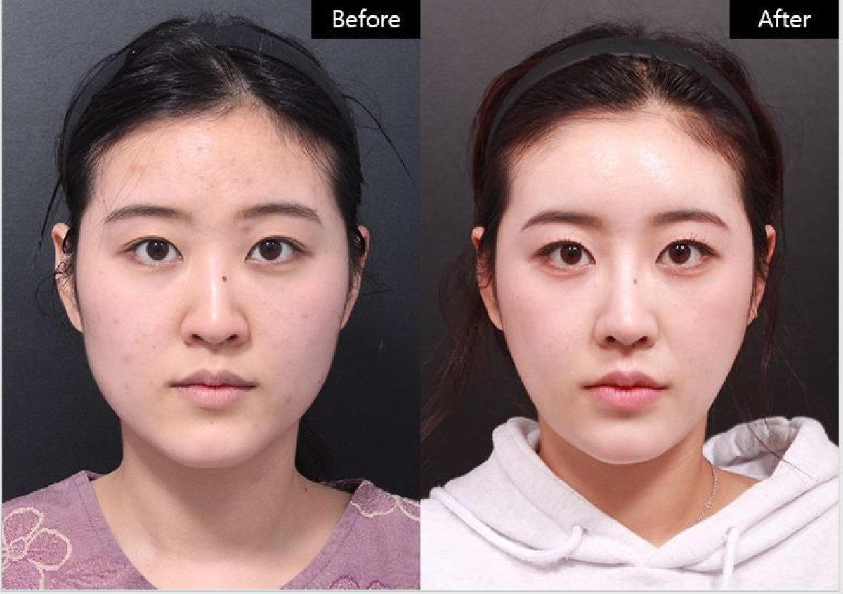 Before and after jawline contouring at VG Plastic Surgery, defined facial shape result