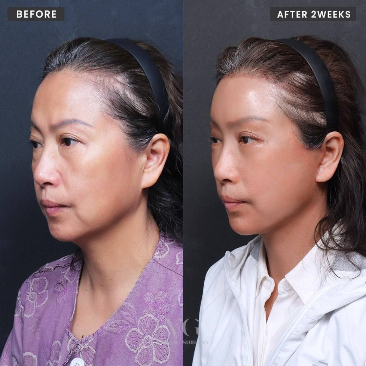 Before and after deep plane facelift results at VG Plastic Surgery, visible facial rejuvenation