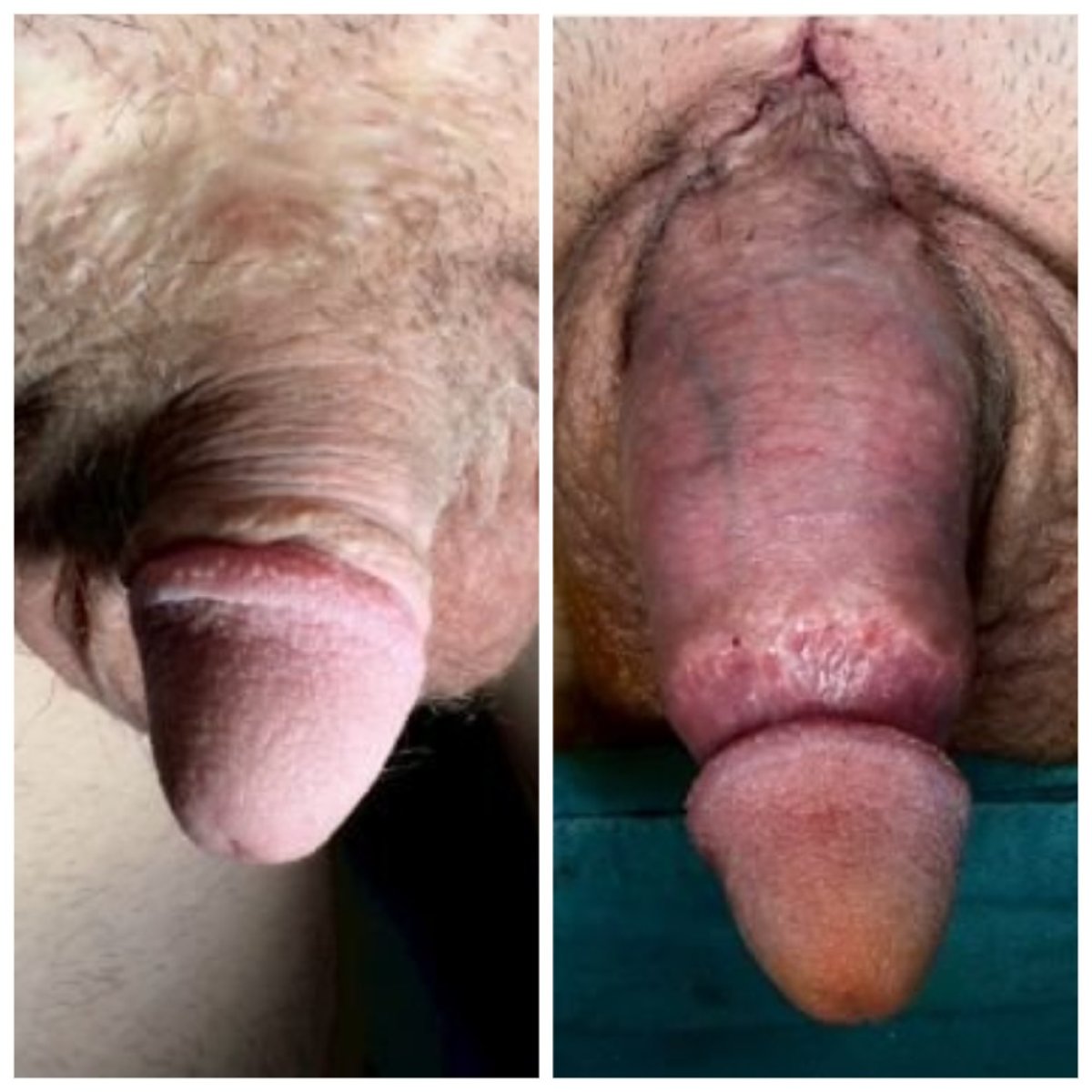 Before and after surgical penile lengthening results at Menness Wellness Clinic