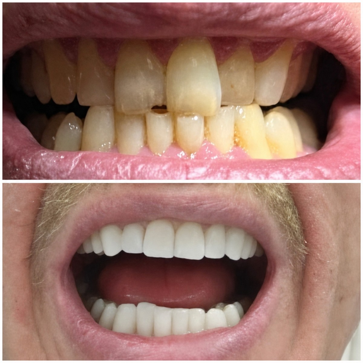 Résultats avant/après détartrage chez Dential Dental Clinic, sourire plus blanc