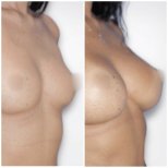 صور قبل وبعد تكبير الثدي للدكتور Maciej Charazinski