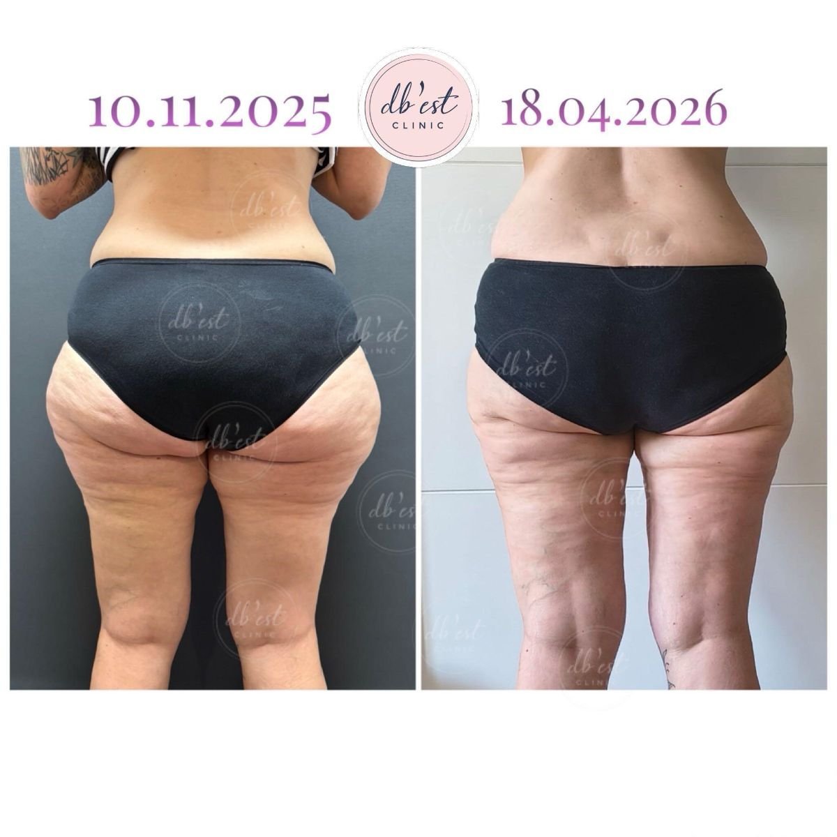 Before and after Vaser liposuction results at Db'est Clinic – improved body contour