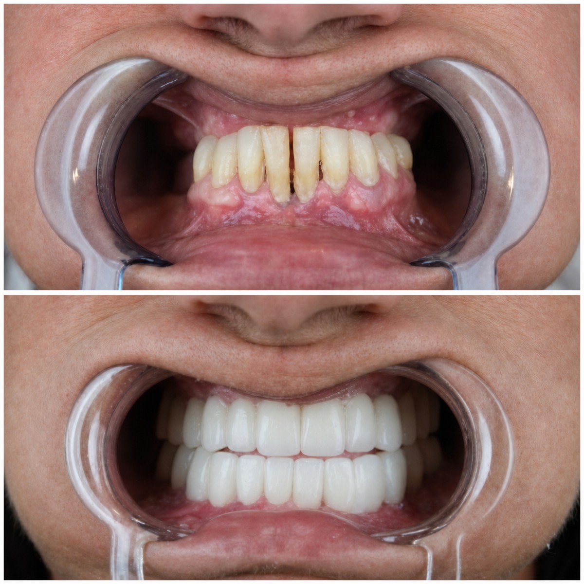 Before and after All-on-6 dental implants result at YEG Clinic – full smile restoration