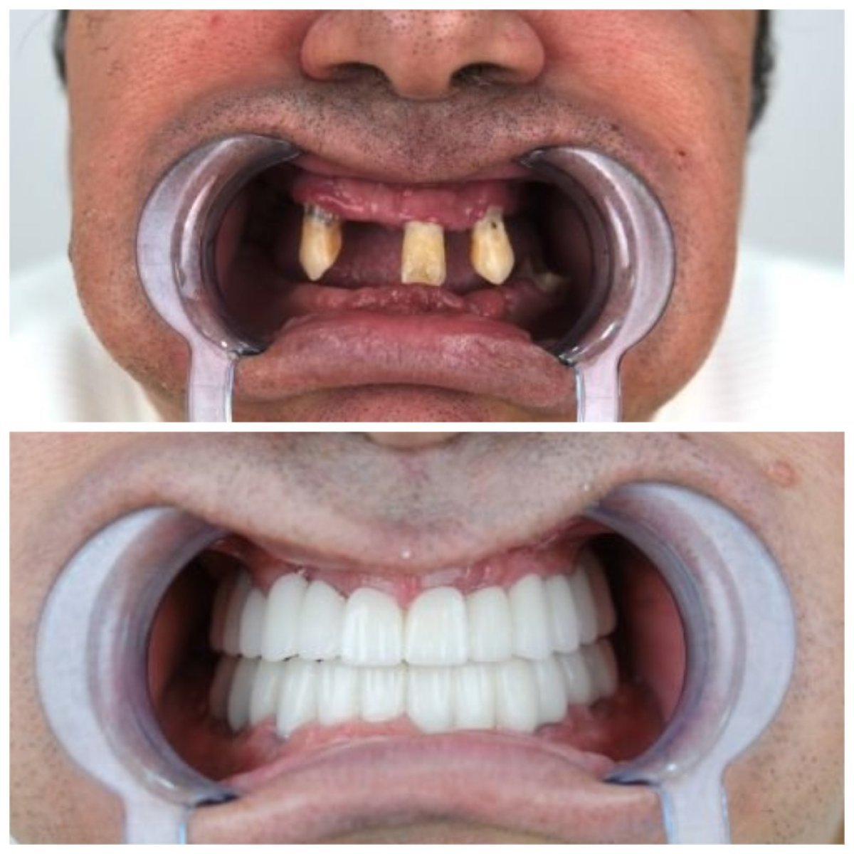 Before and after All-on-6 dental implants result at YEG Clinic, full smile restoration