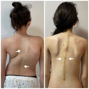 Scoliosis Surgery - photo 4
