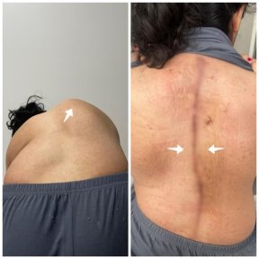 Scoliosis Surgery - photo 5