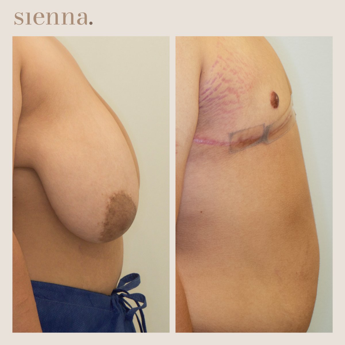 Résultats avant/après chirurgie FTM à la Sienna Clinic – masculinisation du torse